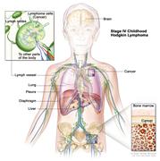 Stage IV childhood Hodgkin lymphoma; drawing shows cancer in the liver, the left lung, and in one lymph node group below the diaphragm. The brain and pleura are also shown. One inset shows cancer spreading through lymph nodes and lymph vessels to other parts of the body. Lymphoma cells containing cancer are shown inside one lymph node. Another inset shows cancer cells in the bone marrow.