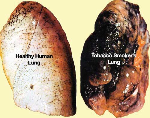 Healthy Human lung next to a tobacco smoker's lung.