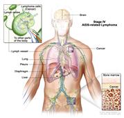 Stage IV AIDS-related lymphoma; drawing shows cancer in the liver, the left lung, and in one lymph node group below the diaphragm. The brain and pleura are also shown. One inset shows a close-up of cancer spreading through lymph nodes and lymph vessels to other parts of the body. Lymphoma cells containing cancer are shown inside one lymph node. Another inset shows cancer cells in the bone marrow.