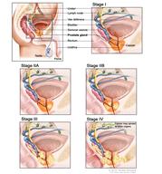Prostate cancer staging; six  panel drawing showing a side view of normal  male  anatomy and closeup views of Stage I, Stage IIA, Stage IIB, Stage III, and Stage IV  showing cancer growing from within the  prostate to nearby tissue and then to lymph nodes or other parts of the body.