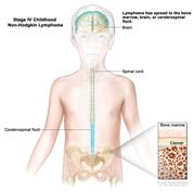 Stage IV childhood non-Hodgkin lymphoma; drawing shows the brain, spinal cord, and cerebrospinal fluid in and around the brain and spinal cord. An inset shows cancer in the bone marrow.