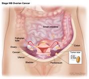 Stage IIIB ovarian cancer; drawing shows tumors inside both ovaries that have spread to the uterus, colon, small intestine, and the peritoneum, where they are 2 centimeters or smaller in diameter. An inset shows 2 centimeters is about the size of a peanut. Also shown are the fallopian tubes and bladder.