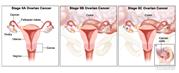 Three-panel drawing of stage IIA, IIB, and IIC ovarian cancer; first panel shows two stage IIA tumors, one inside each ovary, that have spread to the uterus and fallopian tube. The second panel shows two stage IIB tumors, one inside each ovary, that have spread to the uterus, fallopian tube,  and  colon. The third panel shows two stage IIC tumors, one inside each ovary, that have spread to the uterus and colon. An inset shows cancer cells floating in the peritoneal fluid surrounding abdominal organs. Also shown are the cervix and vagina.