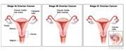 Three-panel drawing of stage IA, IB, and IC ovarian cancer; first panel shows a stage IA tumor inside one ovary. The second panel shows two stage IB tumors, one inside each ovary. The third panel shows two stage IC tumors, one inside each ovary, and one tumor has a ruptured capsule. An inset shows cancer cells floating in the peritoneal fluid surrounding abdominal organs. Also shown are the fallopian tubes, uterus, cervix, and vagina.