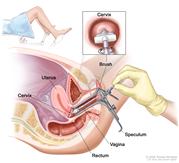 Pap smear; drawing shows a side view of the female reproductive anatomy during a Pap test. A speculum is shown widening the opening of the vagina. A brush is shown inserted into the open vagina and touching the cervix at the base of the uterus. The rectum is also shown. One inset shows the brush touching the center of the cervix. A second inset shows a woman covered by a drape on an exam table with her legs apart and her feet in stirrups.