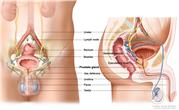 Anatomy of the  male reproductive and urinary systems; drawing shows front and side views of ureters, lymph nodes, rectum, bladder, prostate gland, vas deferens,  penis, testicles, urethra, seminal vesicle, and ejaculatory duct.