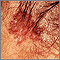 Cáncer de piel o carcinoma de célula basal pigmentado