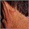 Cáncer de piel o carcinoma de célula basal detrás de la oreja