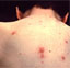 boy with chickenpox