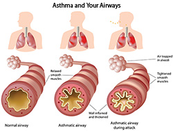 Pathology of Asthma illustration