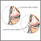 Ligamento colateral lateral desgarrado