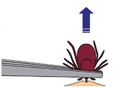 a tick being removed