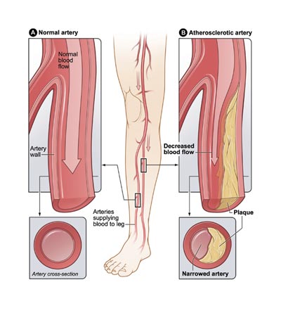 an illustration of Normal artery and Atherosclerotic artery