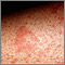 Primer plano del eczema atópico
