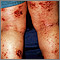 Dermatitis atópica de las piernas