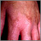 Fitofotodermatitis de la mano