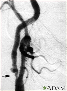 Estenosis carotídea; radiografía de la arteria derecha