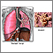 Pulmones y alveolos normales