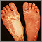 Síndrome de Sturge-Weber; plantas de los pies