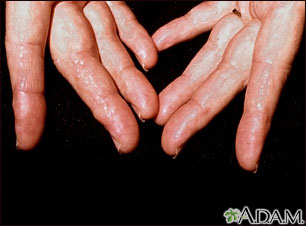 Amiloidosis en los dedos