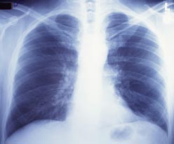 Chest X-ray Image