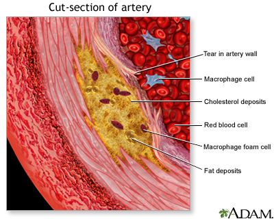 Enlarged view of atherosclerosis