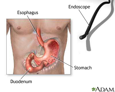 Gastric endoscopy