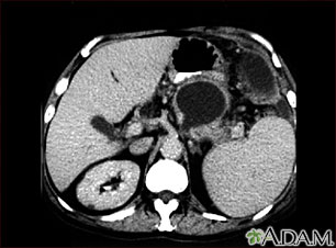 Seudoquiste pancreático, Tomografía computarizada