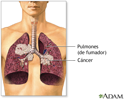 Humo de segunda mano y cáncer de pulmón