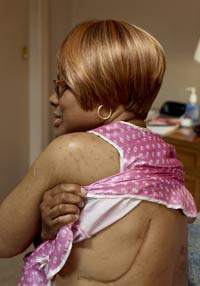 Photo: A woman showing surgery scar on back
