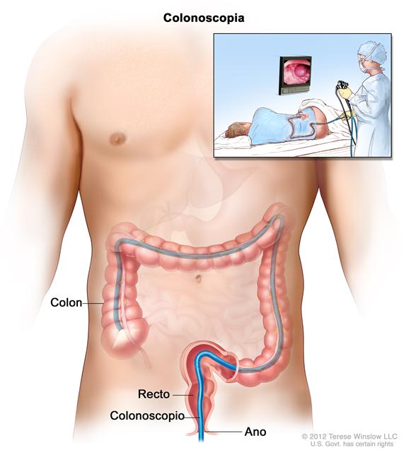 Colonoscopia; muestra un colonoscopio que se inserta a través del ano y el recto hacia el colon. El recuadro interior muestra la imagen de un paciente en camilla al que se le realiza una colonoscopia.