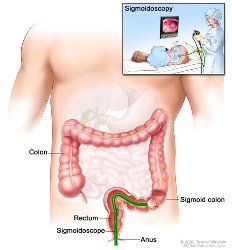 Image shows sigmoidoscope inserted through the anus and rectum and into the sigmoid colon. Inset shows patient on table having a sigmoidoscopy.