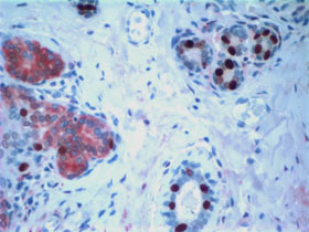 Tejido de cáncer de mama de una mujer que tenía una mutación del gen BRCA1. Las células madre cancerosas aparecen en rojo y los receptores de estrógeno en marrón. (Cortesía  del Centro Oncológico Integral de la Universidad de Michigan).