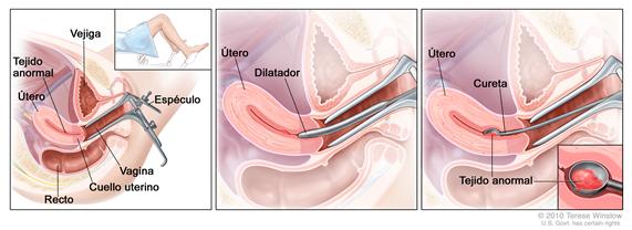 Dilatación y curetaje (DyC). Dibujo de tres paneles que muestra una vista lateral de la anatomía del aparato reproductor femenino durante un procedimiento de DyC. El primer panel muestra un espéculo que ensancha la abertura de la vagina. También se muestra el cuello uterino, el útero con tejido anormal, la vejiga y el recto; en una recuadro se muestra la parte inferior de una mujer cubierta por una sábana sobre una camilla con las piernas separadas y sus pies apoyados en los estribos. El panel del medio muestra el útero y un dilatador que se introduce por la vagina hacia el cuello uterino. El tercer panel muestra una cureta que raspa el tejido anormal del útero; en un recuadro se muestra una ampliación de la cureta con tejido anormal.