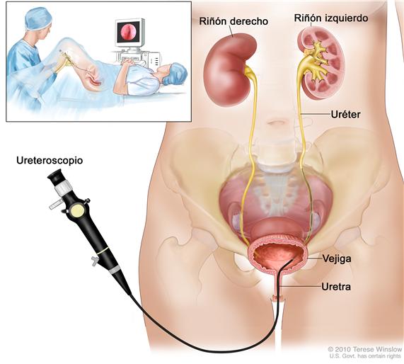 Ureteroscopía; el dibujo muestra la pelvis que contiene los riñones derecho e izquierdo, el uréter, la vejiga y la uretra.  El tubo flexible del ureteroscopio  (un instrumento en forma de tubo delgado con luz y una lente para observar) se ve pasando a través de la uretra hacia la vejiga y el uréter.   En un recuadro se ve una mujer acostada en una            mesa de exploración con las rodillas dobladas y las piernas separadas. La mujer esta cubierta con una sábana.  El médico observa la imagen del interior del uréter en el monitor de la computadora.