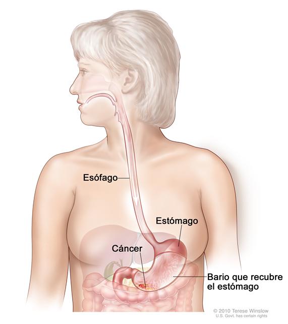 Ingesta de bario para el cáncer de estómago; el dibujo muestra el bario líquido que fluye a través del esófago y hacia el estómago.