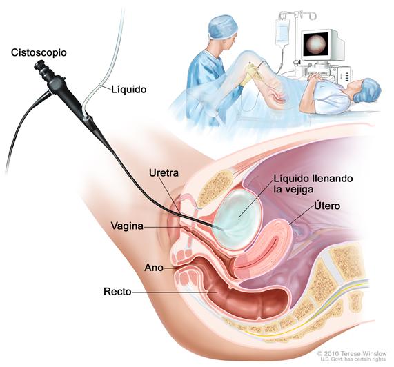 Cistoscopia;  el dibujo muestra una vista lateral de la pelvis inferior que contiene la vejiga, el útero y el recto.   También se ven la vagina y el ano.   Se muestra el tubo flexible de un cistoscopio (instrumento delgado similar a un tubo, con una luz y una lente para observar) que pasa a través de la uretra y hacia la vejiga. Se usa líquido para llenar la vejiga. En un recuadro, se observa el dibujo de una mujer en una mesa de examen, con las rodillas dobladas y piernas separadas. Está  cubierta por una sábana. El médico observa una imagen de la pared interna de la vejiga en el monitor de una computadora.