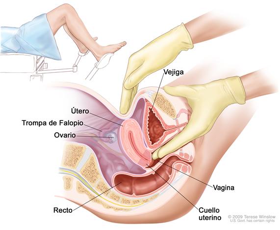 Examen pélvico; la imagen muestra una vista de costado de la anatomía del aparato reproductor femenino durante un examen pélvico. Se observa el útero, la trompa de Falopio izquierda, el ovario izquierdo, el cuello uterino, la vagina, la vejiga y el recto. El médico o enfermero introducen dos dedos enguantados en la vagina, mientras se ve la otra mano presionando en la parte inferior del abdomen. El recuadro muestra a una mujer cubierta por un paño sobre una camilla con sus piernas separadas y sus pies colocados en estribos.