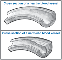 Two drawings: The top drawing is of a cross section of a healthy blood vessel. A label says 