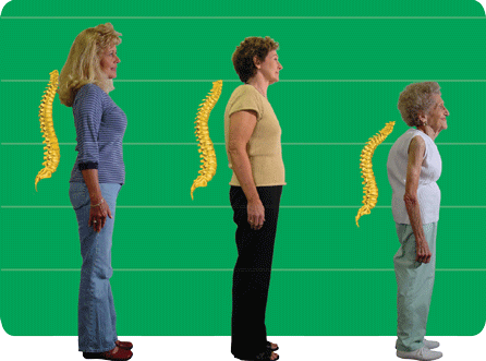 Images of female adults starting with young to middle-aged to older showing how weak bones can cause the spine to collapse as we age.