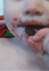 Hand, Foot, and Mouth Disease Caused by Coxsackievirus A6