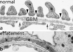 Many proteinuric diseases are characterized by loss of the glomerular slit diaphragms appearance of a continuous layer of podocyte cytoplasm