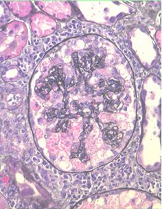 collapsing glomerulopathy (also termed collapsing FGSGS)