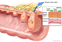 illustration of colorectal cancer stages.