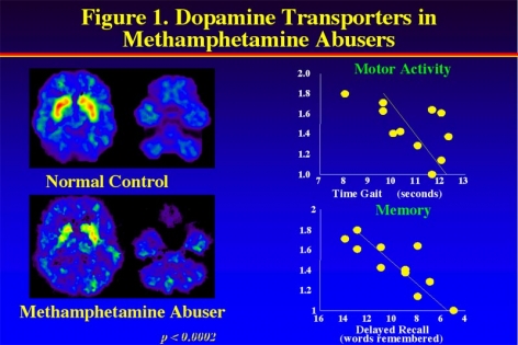PET image showing decreased activity of dopamine transporters in Methamphetamine abusers