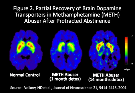 Figure 2. Partial Recovery of Brain Dopamine Transporters in Methamphetamine (METH) Abuser After Protracted Abstinence