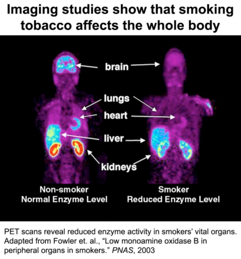 Imaging studies show that smoking tobacco affects the whole body image