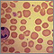 Glóbulos rojos con esferocitosis