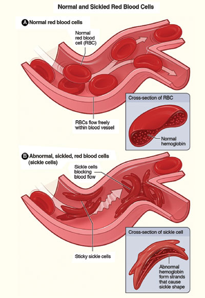A diagram showing normal and sickled red blood cells