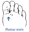 Drawing of the bottom of a foot with an arrow pointing to plantar warts.